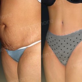 Before and after Vaser liposuction results at Memorial Şişli Hospital, abdomen contouring