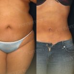 Before and after Vaser liposuction results at Memorial Şişli Hospital, improved body contour