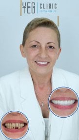 Résultats avant/après smile makeover à YEG Clinic – transformation dentaire visible