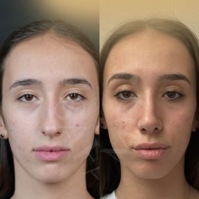 Vorher-nachher-Ergebnisse der Nasenkorrektur in der Dr. Safa Manav Klinik, Nasenform verbessert