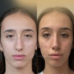 Vorher-nachher-Ergebnisse der Nasenkorrektur in der Dr. Safa Manav Klinik, Nasenform verbessert