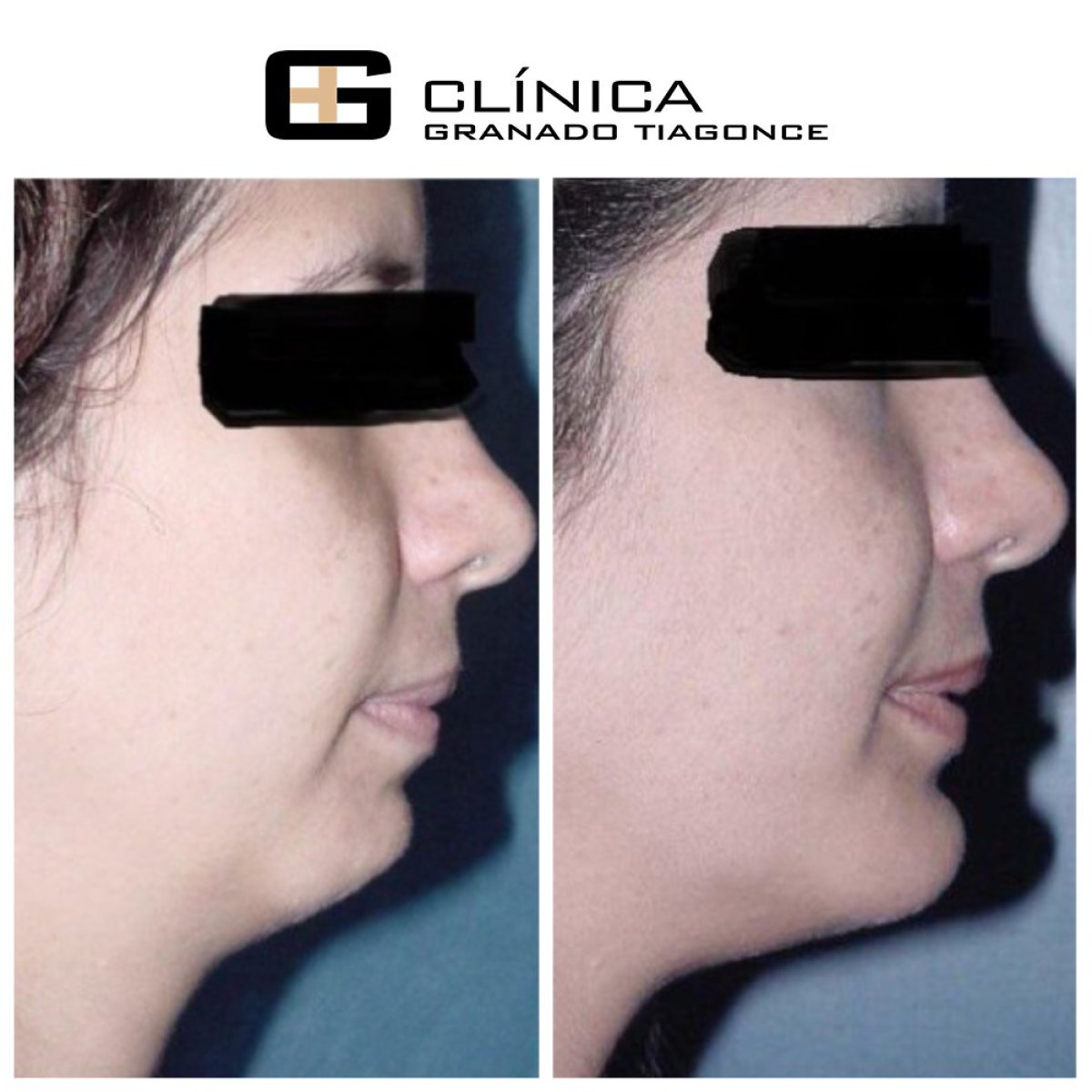 نتائج قبل وبعد زراعة الذقن في Clinica Granado Tiagonce، تحسين مظهر الذقن