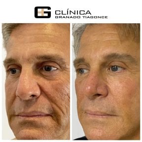 Resultados de lifting facial antes y después en Clinica Granado Tiagonce, rejuvenecimiento