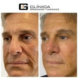 Resultados de lifting facial antes y después en Clinica Granado Tiagonce, rejuvenecimiento