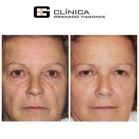 Resultados de lifting facial antes y después en Clinica Granado Tiagonce, rejuvenecimiento visible