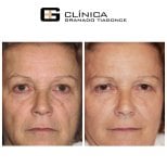 Resultados de lifting facial antes y después en Clinica Granado Tiagonce, rejuvenecimiento visible