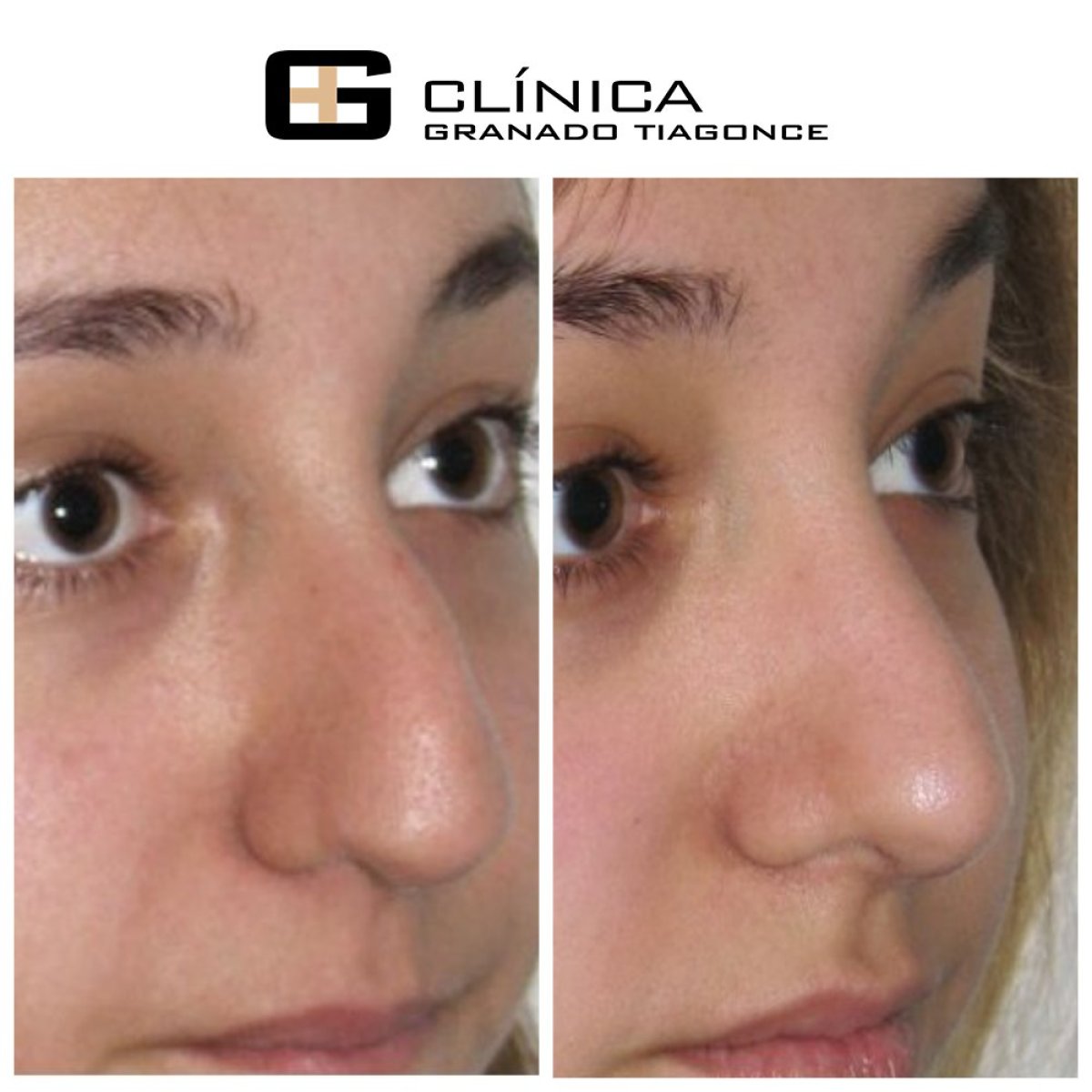 نتائج تجميل الأنف قبل وبعد في Clinica Granado Tiagonce، إعادة تشكيل الأنف