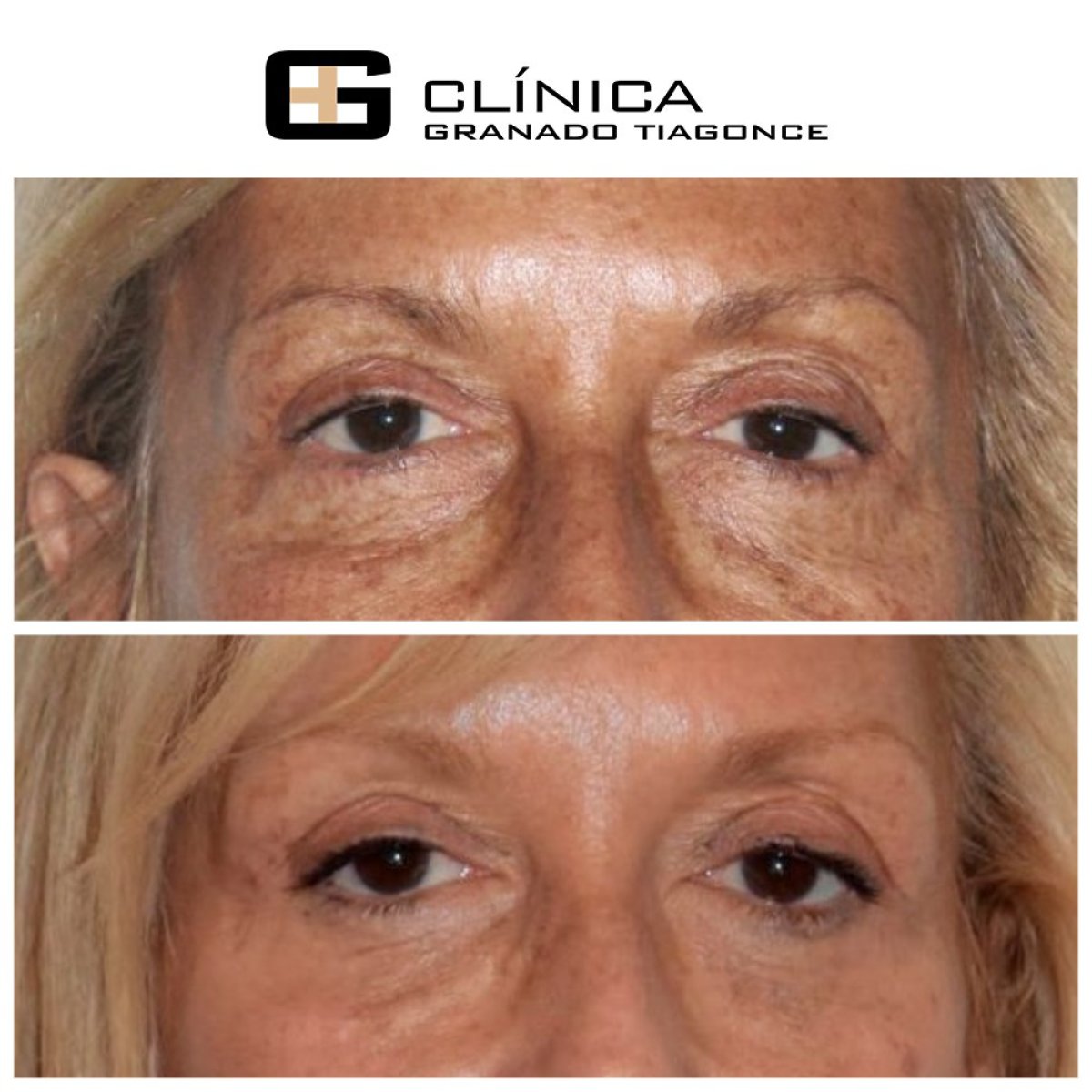 Resultados de blefaroplastia antes y después en Clinica Granado Tiagonce, corrección de párpados