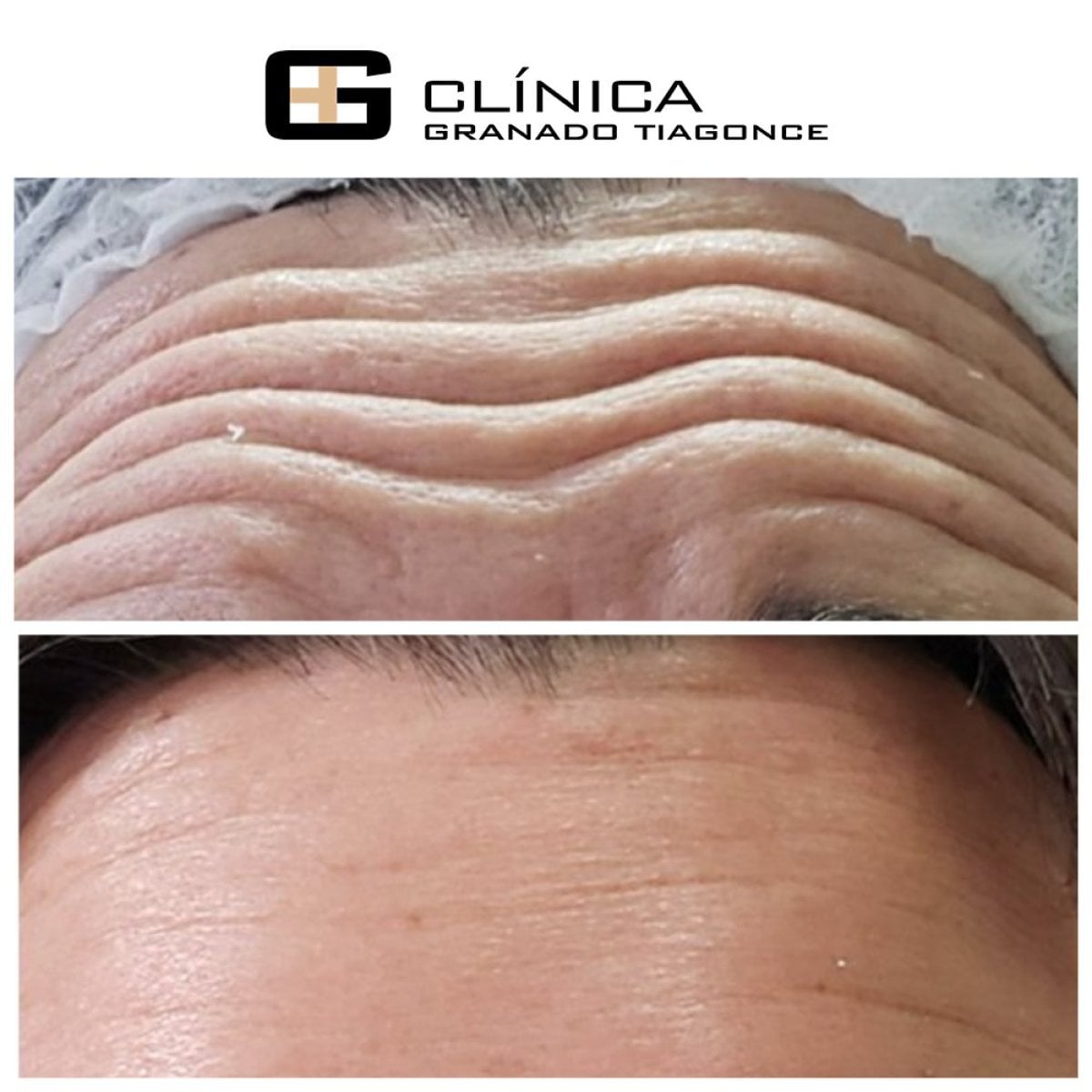 قبل وبعد حقن البوتوكس في Clinica Granado Tiagonce، تقليل تجاعيد الجبهة