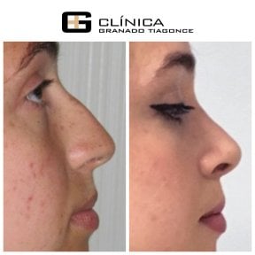 Результаты ринопластики до и после в Clinica Granado Tiagonce, коррекция формы носа