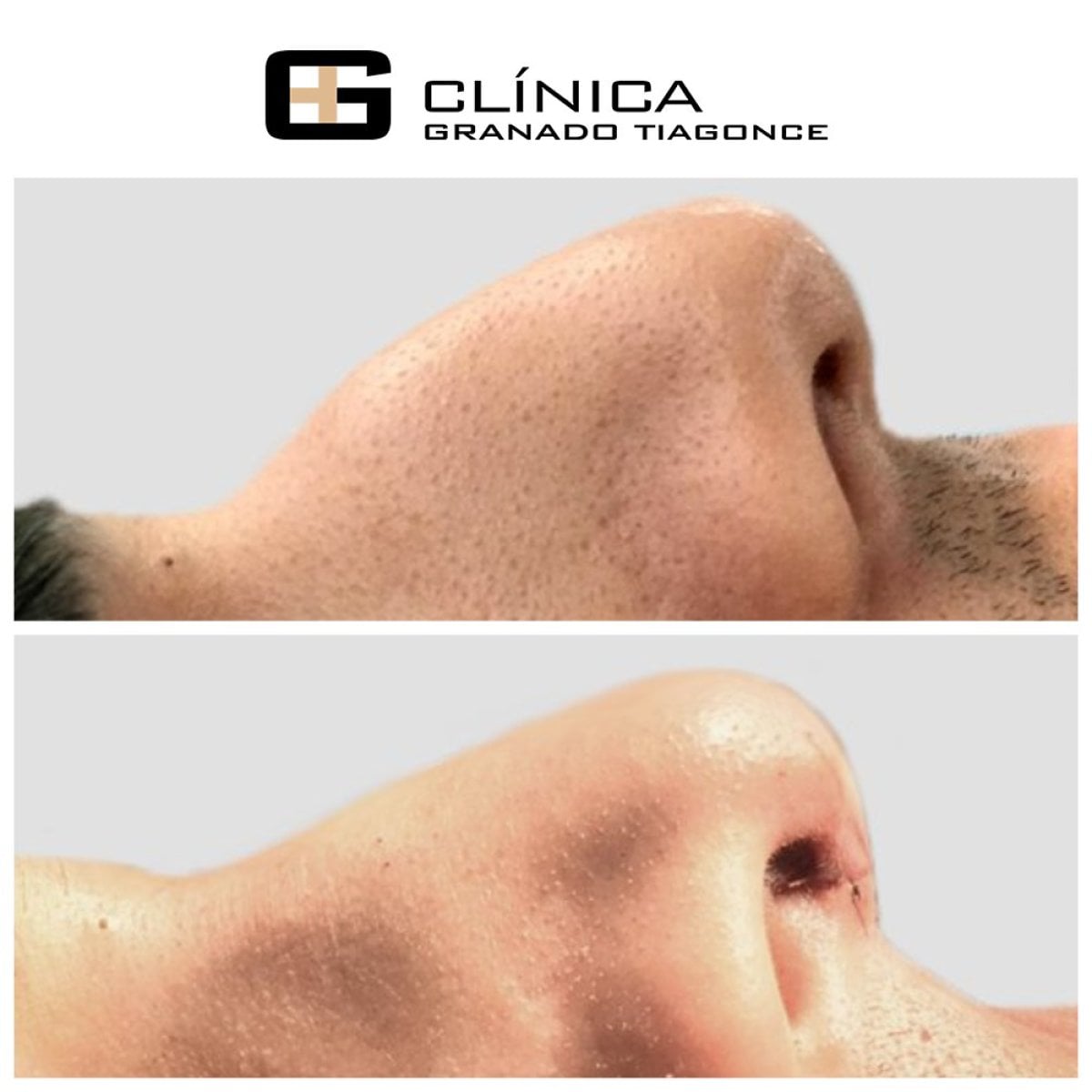 Resultados de rinoplastia antes y después en Clinica Granado Tiagonce, perfil nasal mejorado