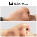 Результаты ринопластики до и после в Clinica Granado Tiagonce, улучшенный профиль носа