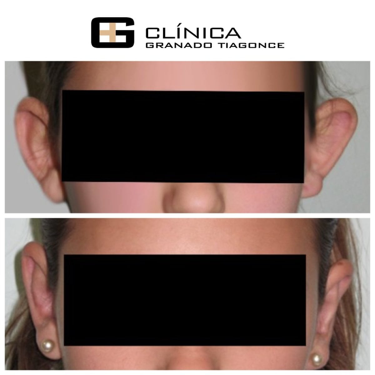 نتائج عملية تجميل الأذن قبل وبعد في Clinica Granado Tiagonce، تصحيح شكل الأذن