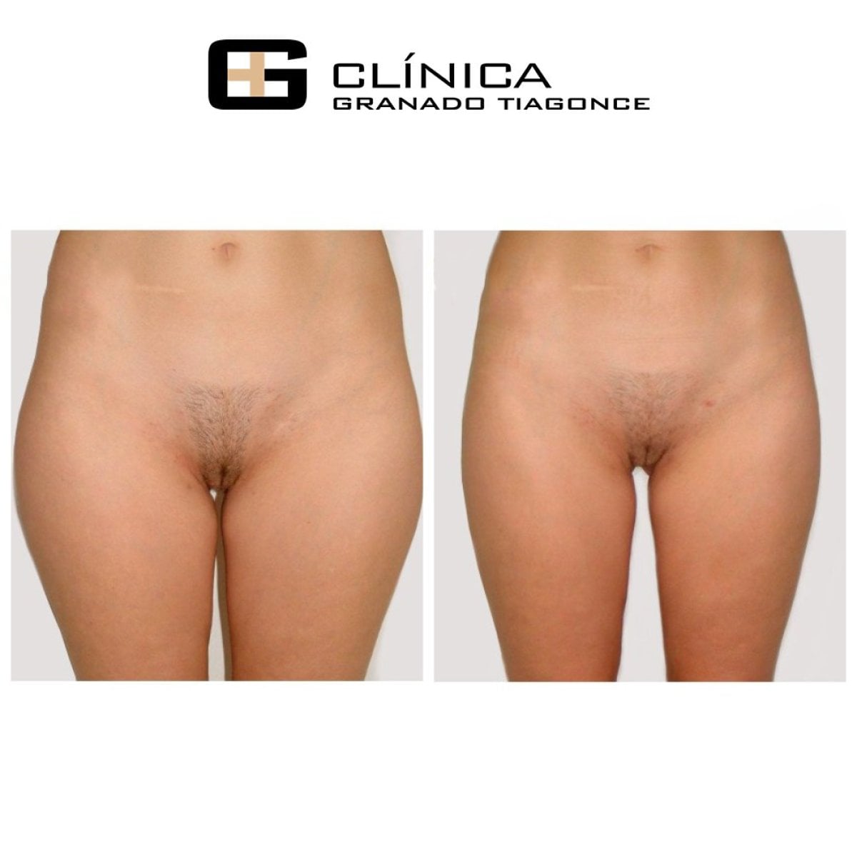 Resultados de liposucción antes y después en Clinica Granado Tiagonce, contorno de muslos
