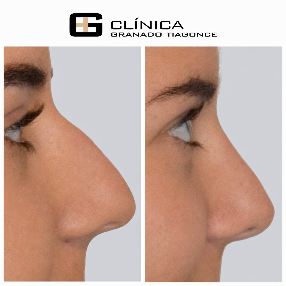 نتائج تجميل الأنف قبل وبعد في Clinica Granado Tiagonce، إعادة تشكيل الأنف