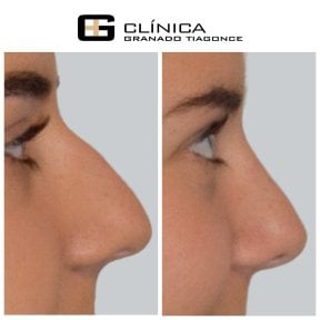 Результаты ринопластики до и после в Clinica Granado Tiagonce, коррекция носа