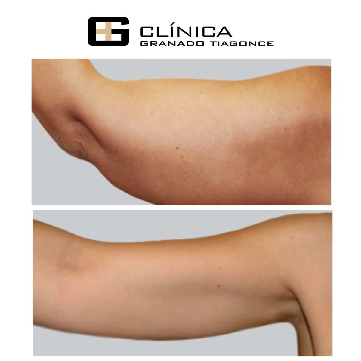 Resultados antes y después de lifting de brazos en Clinica Granado Tiagonce, braquioplastia
