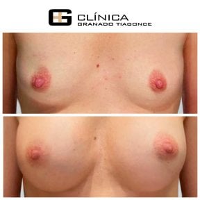 نتائج قبل وبعد تكبير الثدي في Clinica Granado Tiagonce، تحسين شكل الثدي