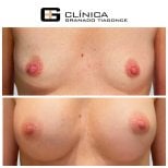 نتائج قبل وبعد تكبير الثدي في Clinica Granado Tiagonce، تحسين شكل الثدي