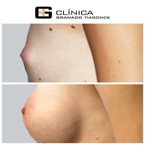 نتائج تكبير الثدي قبل وبعد في Clinica Granado Tiagonce، زيادة الحجم