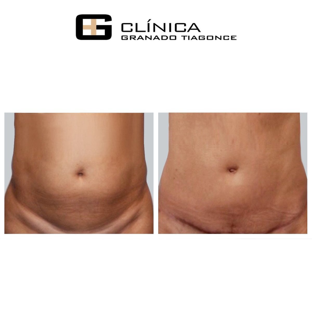 Resultados de abdominoplastia antes y después en Clinica Granado Tiagonce, abdomen mejorado