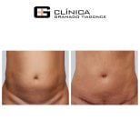 نتائج شد البطن قبل وبعد في عيادة Granado Tiagonce، تحسين شكل البطن