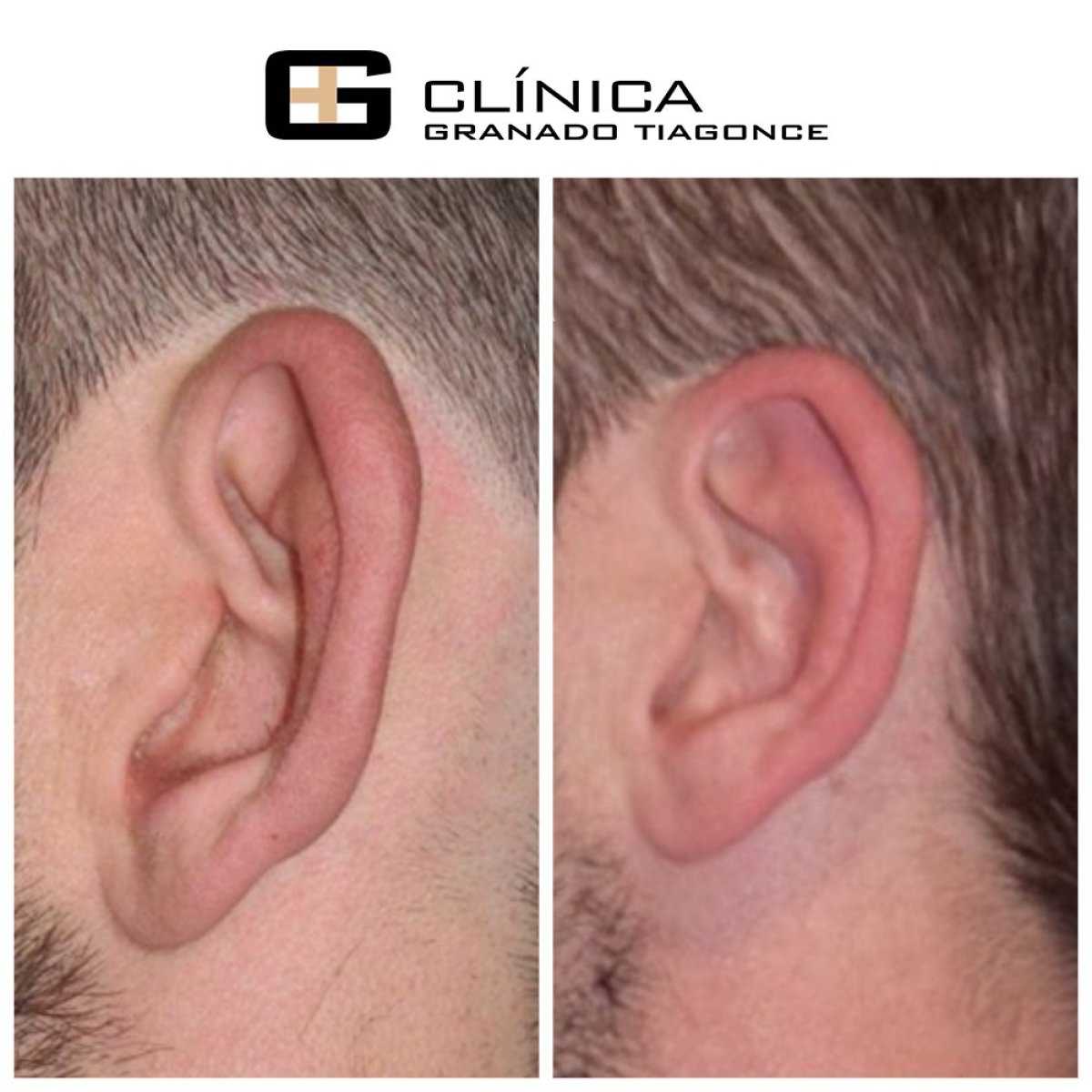 Resultados de otoplastia antes y después en Clinica Granado Tiagonce, cirugía de orejas
