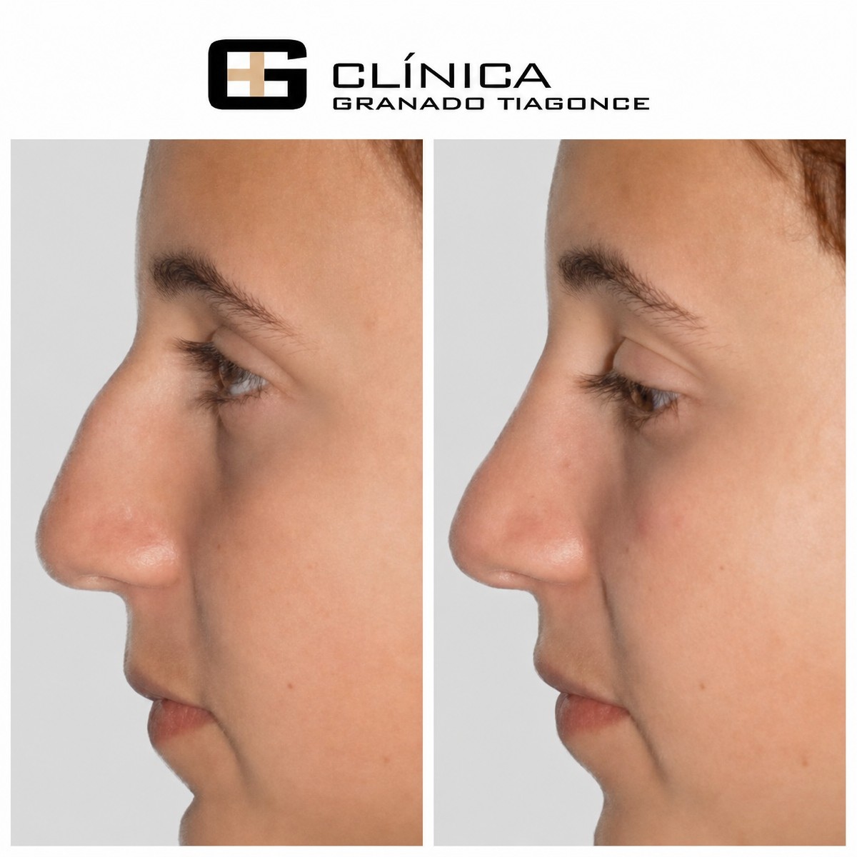 Resultados de rinoplastia antes y después en Clinica Granado Tiagonce, remodelación nasal