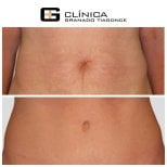 Результаты до и после абдоминопластики в Clinica Granado Tiagonce, улучшенный контур живота