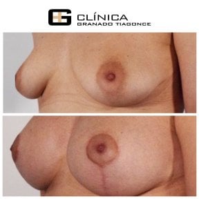 نتائج تكبير الثدي قبل وبعد في Clinica Granado Tiagonce، ثديان أكثر امتلاءً