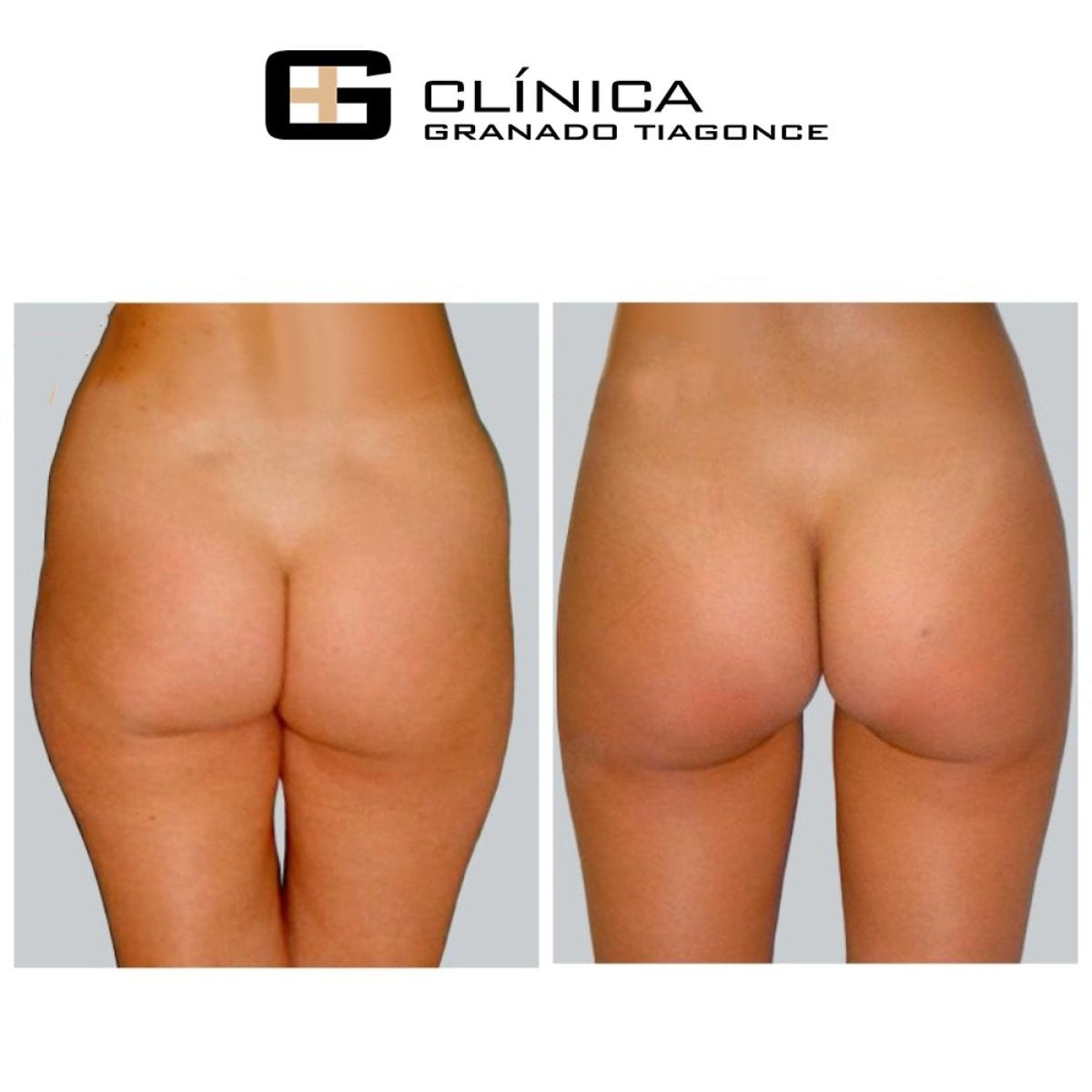 Antes y después de liposucción en 3 zonas en Clinica Granado Tiagonce, resultado visible