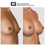 قبل وبعد تكبير الثدي في Clinica Granado Tiagonce، نتيجة زيادة حجم الثدي