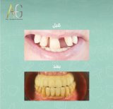 Fotos vor und nach Zahnimplantat durch Dr.