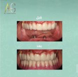 Fotos vor und nach Zahnimplantat durch Dr.