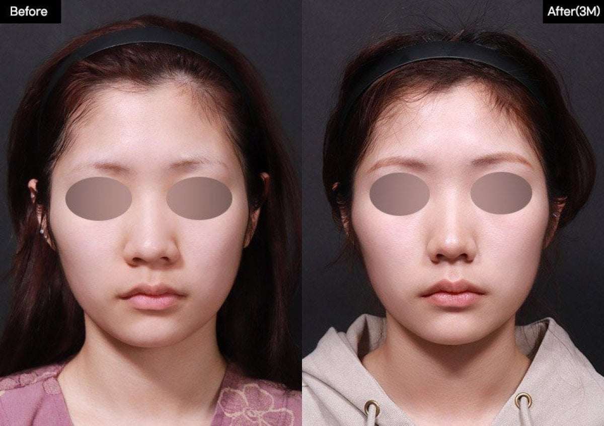 Resultados antes y después de alarplastia en VG Plastic Surgery, mejor forma y simetría nasal