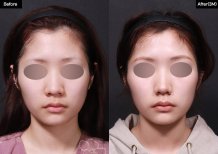 Vorher-nachher-Ergebnis der Alarplastik bei VG Plastic Surgery, verbesserte Nasenform