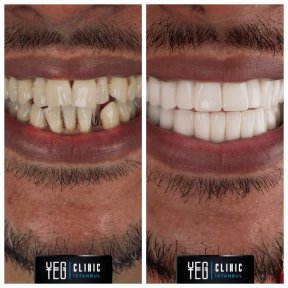نتائج زراعة الأسنان قبل وبعد في YEG Clinic – ابتسامة مستعادة ومظهر طبيعي