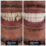 نتائج زراعة الأسنان قبل وبعد في YEG Clinic – ابتسامة مستعادة ومظهر طبيعي