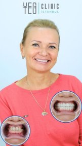 نتائج زراعة الأسنان قبل وبعد في YEG Clinic – ابتسامة وأسنان محسّنة