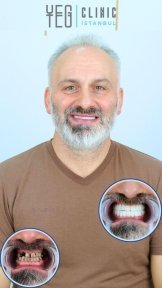 نتائج زراعة الأسنان قبل وبعد في YEG Clinic، ابتسامة محسنة وأسنان مستعادة