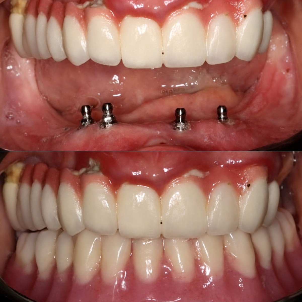 Resultados antes y después de implantes dentales en PyraMedicine: restauración de dientes inferiores