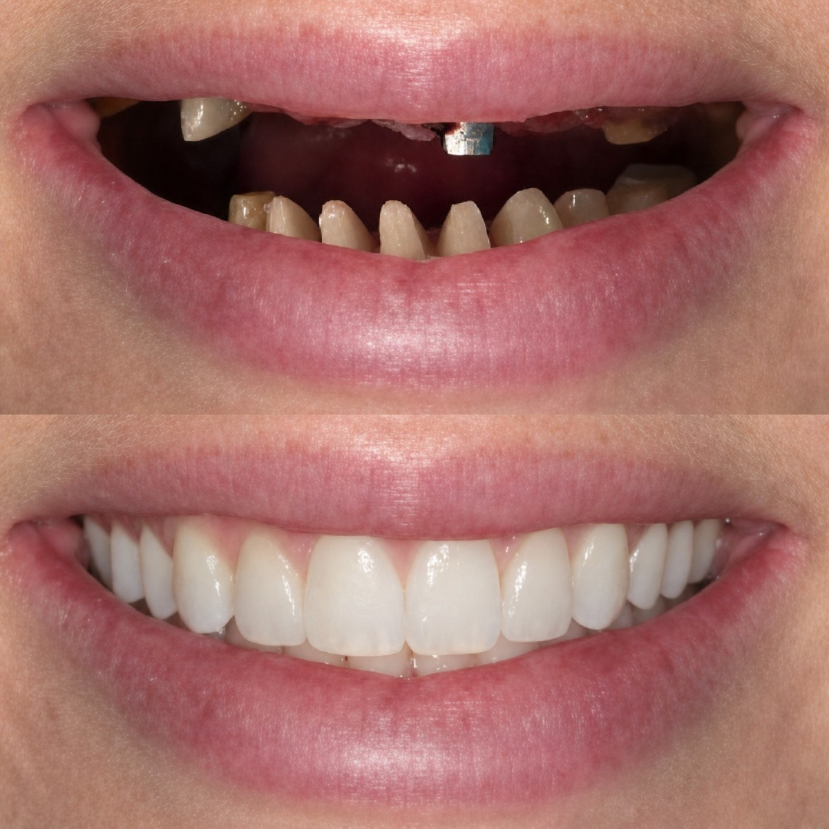 نتائج قبل وبعد زراعة الأسنان في Excelentis Dental Center – ابتسامة طبيعية مستعادة