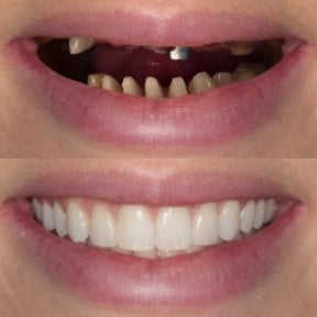 Resultados antes y después de implantes dentales en Excelentis Dental Center – sonrisa restaurada