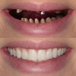 Resultados antes y después de implantes dentales en Excelentis Dental Center – sonrisa restaurada