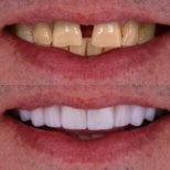 نتائج قبل وبعد زراعة الأسنان في Excelentis Dental Center، ابتسامة طبيعية مستعادة
