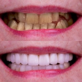 نتائج قبل وبعد زراعة الأسنان في Excelentis Dental Center، تحسين جمالية الابتسامة