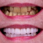 نتائج قبل وبعد زراعة الأسنان في Excelentis Dental Center، تحسين جمالية الابتسامة