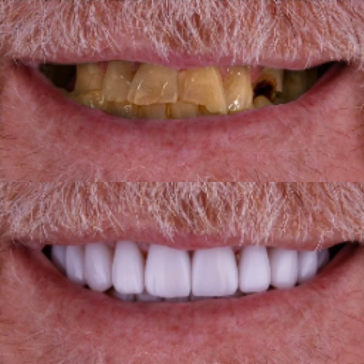 نتائج قبل وبعد زراعة الأسنان في Excelentis Dental Center، ابتسامة طبيعية مستعادة