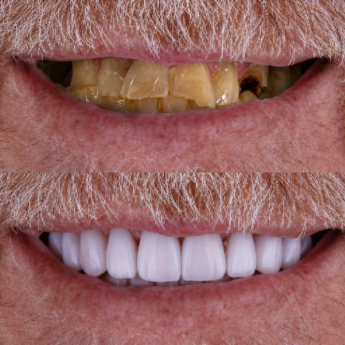 نتيجة قبل وبعد زراعة الأسنان All-on-4 في Excelentis Dental Center، استعادة الابتسامة