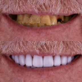 نتيجة قبل وبعد زراعة الأسنان All-on-4 في Excelentis Dental Center، استعادة الابتسامة